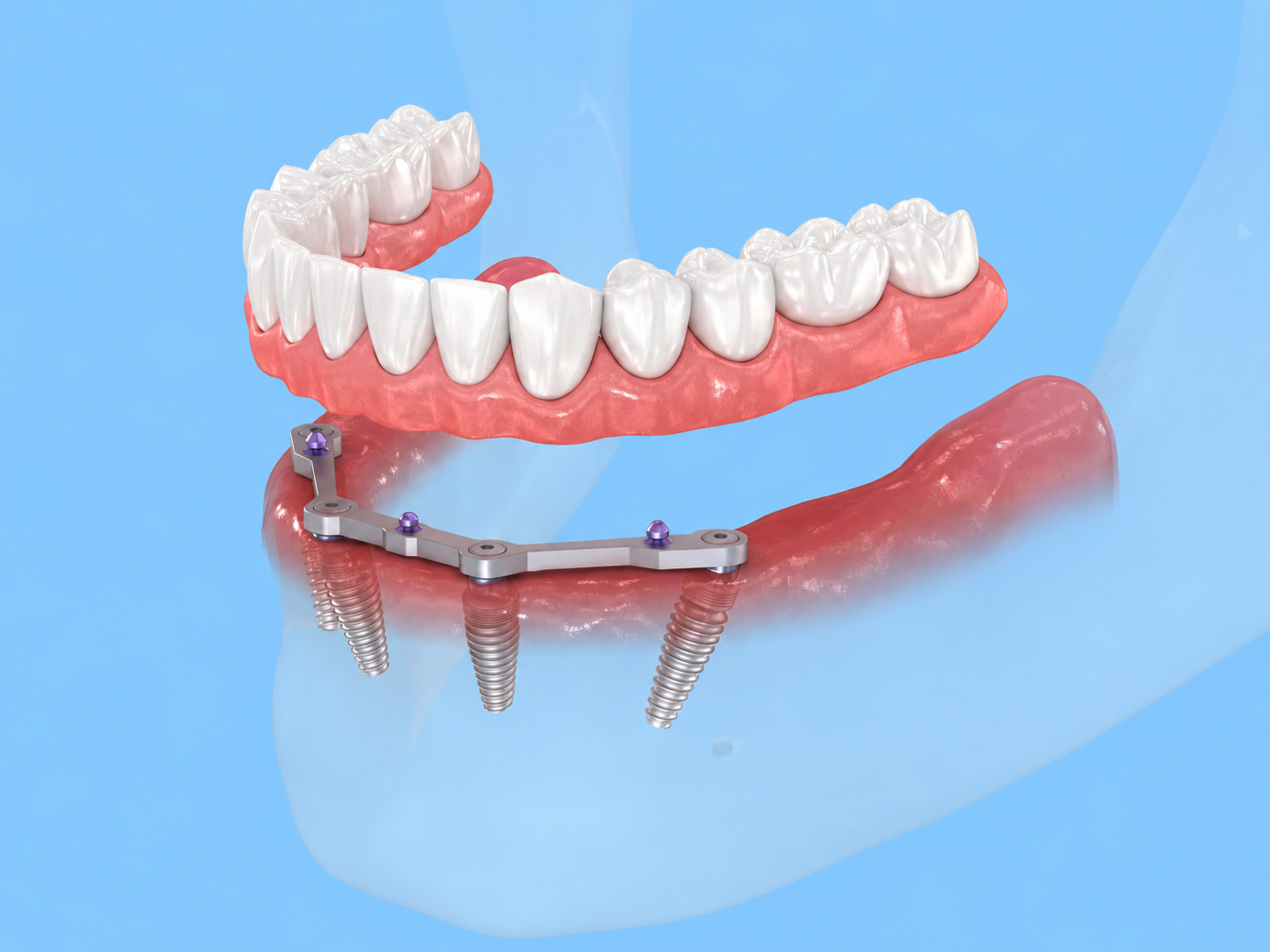 Not every All-on-4 patient requires bone grafting